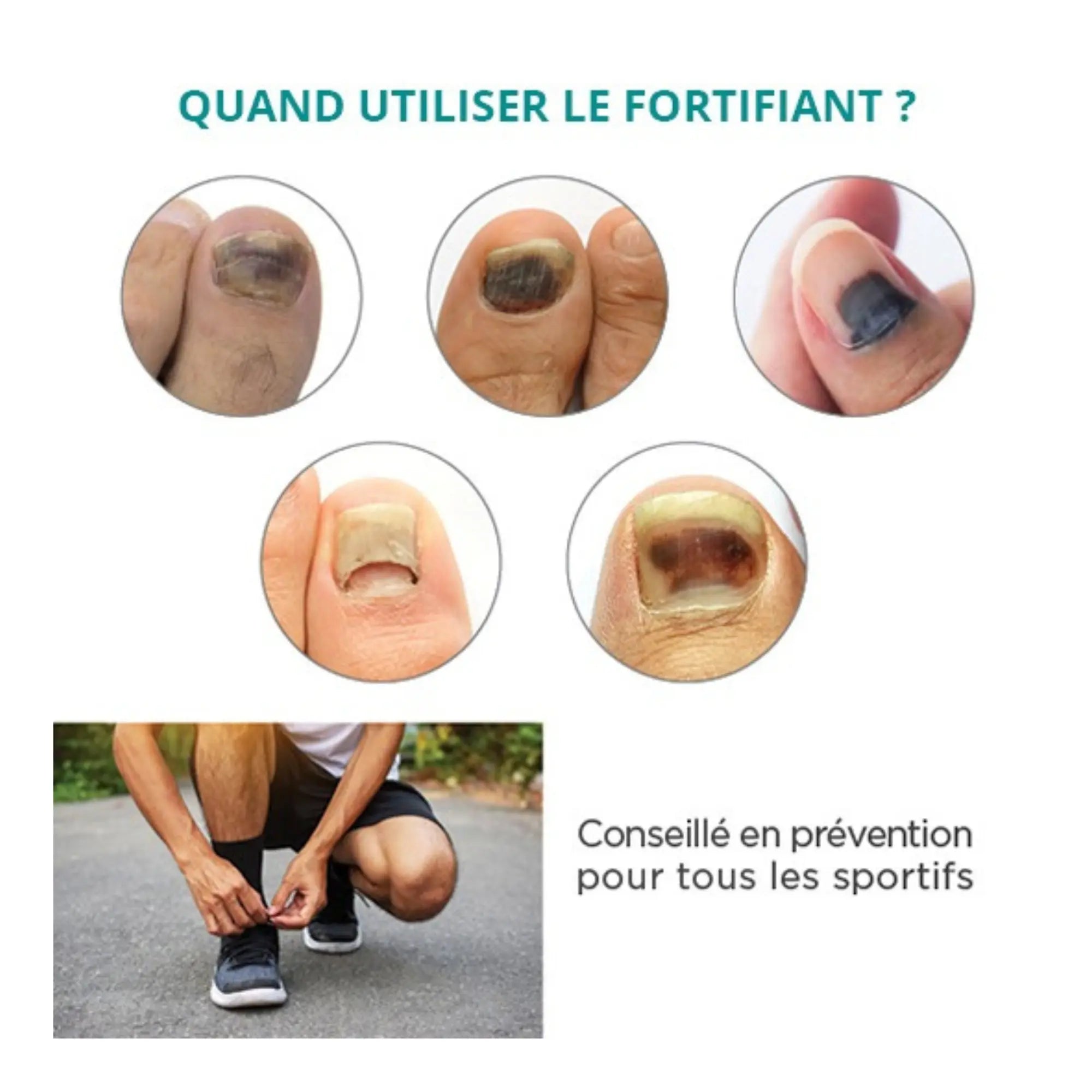 Traitement Ongles noirs, traumatisés - 30ml - Fortifiant - Application avec pipette - Poderm Professional